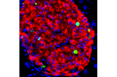 A new therapy for treating Type 1 diabetes